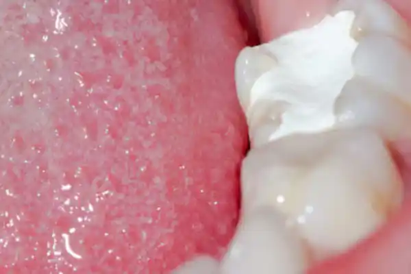 Gigi Ngilu Setelah Ditambal